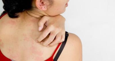 Skin Diseases (Dermatitis)